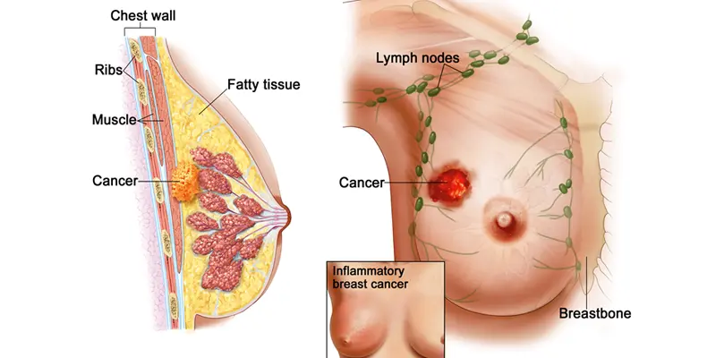 Ung thư vú phát triển từ các tế bào ác tính, bắt nguồn từ thành của ống dẫn sữa hoặc tiểu thuỳ ở tuyến vú
