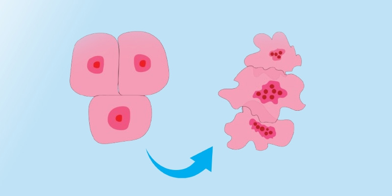 Ung thư vú Luminal A thường có tiên lượng tốt nếu phát hiện sớm
