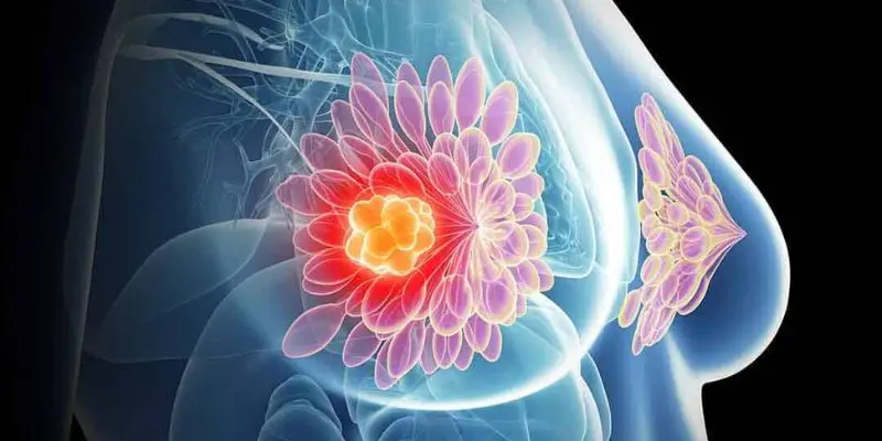 Tiên lượng sống của người bệnh ung thư vú chịu ảnh hưởng bởi nhiều yếu tố phức tạp sau.