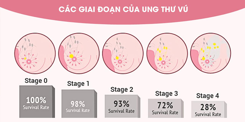 Các giai đoạn của ung thư vú