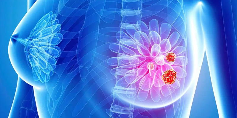 Ung thư vú thể tủy có nguy hiểm không