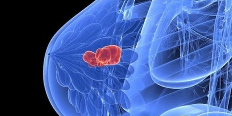 Ung thư vú thể tủy có khả năng phát triển lan rộng đến các phần khác của cơ thể