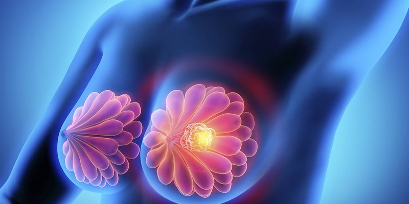 Ung thư vú tiểu thùy xâm nhập là gì