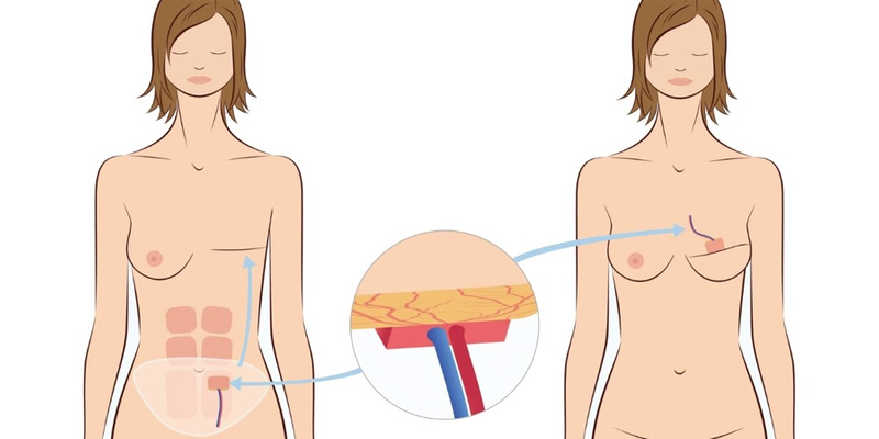 Vạt tự thân có tương thích cao, tạo bầu ngực tự nhiên và duy trì hiệu quả thẩm mỹ lâu dài