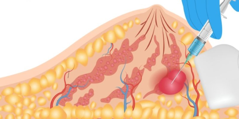 Mổ u vú trong khoảng 2 tuần thì lành