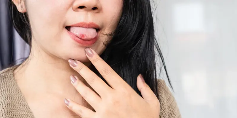 Vết loét trên lưỡi là dấu hiệu của ung thư lưỡi