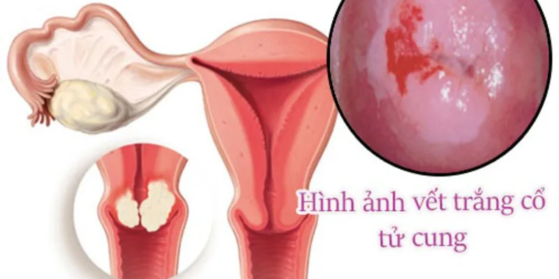 Vết trắng tử cung dạng mảng trắng