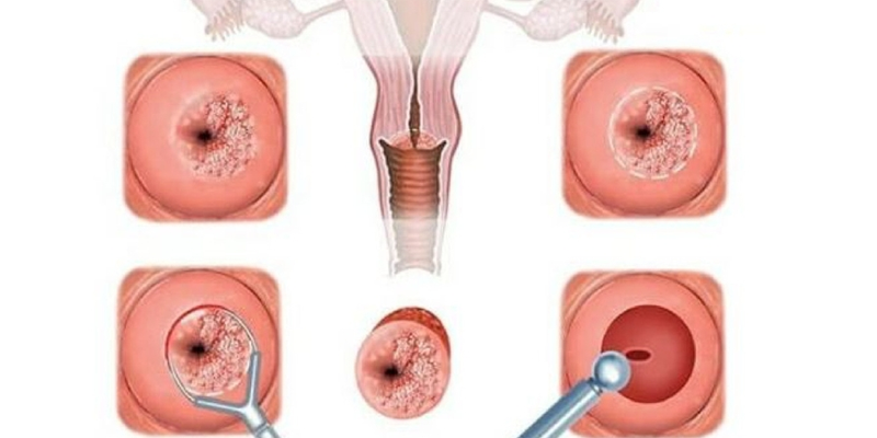 Nhiều người hoang mang không biết vết trắng cổ tử cung có phải ung thư không?