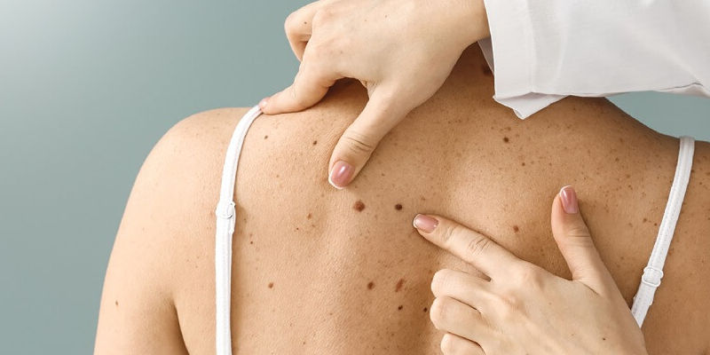 Sàng lọc ung thư da giúp bác sĩ xác định giai đoạn, loại ung thư để đề xuất hướng điều trị phù hợp với thể trạng người bệnh