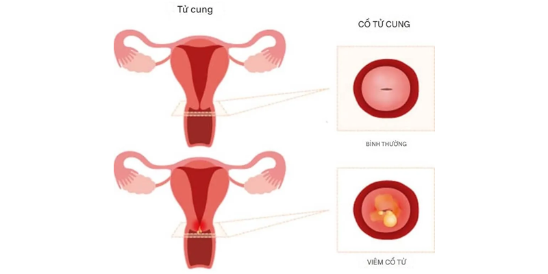 Tình trạng viêm ở cổ tử cung có thể gặp ở nhiều đối tượng, đặc biệt là phụ nữ trong độ tuổi sinh sản