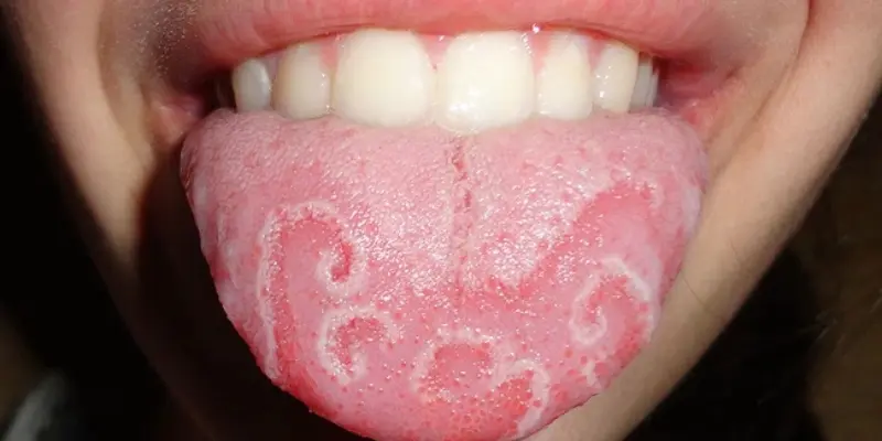 Viêm lưỡi di trú ở trẻ em