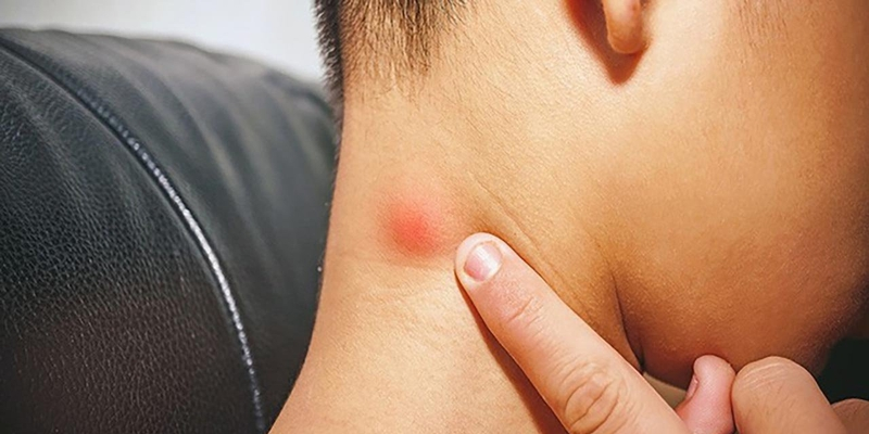 Sưng hạch ở vùng cổ là dấu hiệu bệnh u lympho không Hodgkin