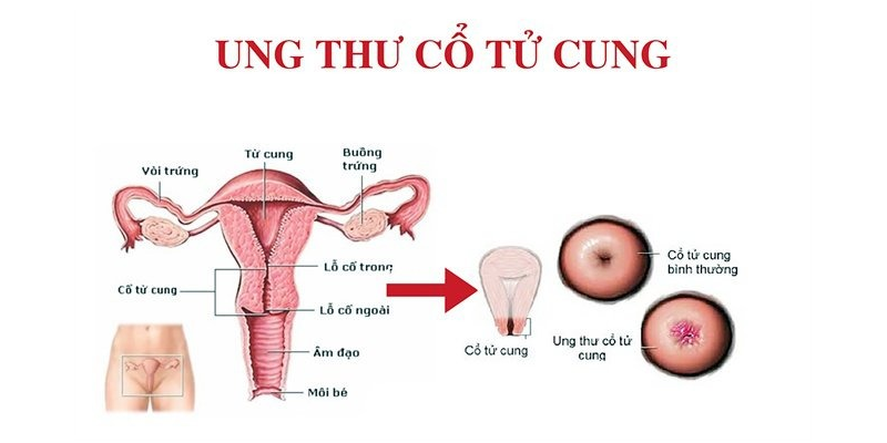 Tiêu diệt các tế bào ung thư cổ tử cung