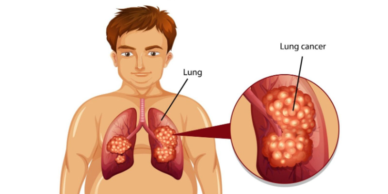 Xạ trị ung thư phổi bao nhiêu tiền