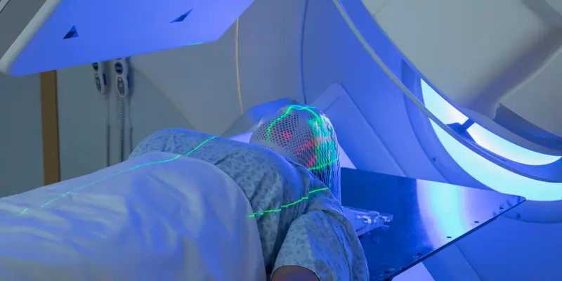 Xạ trị ung thư vòm họng là biện pháp điều trị chủ yếu