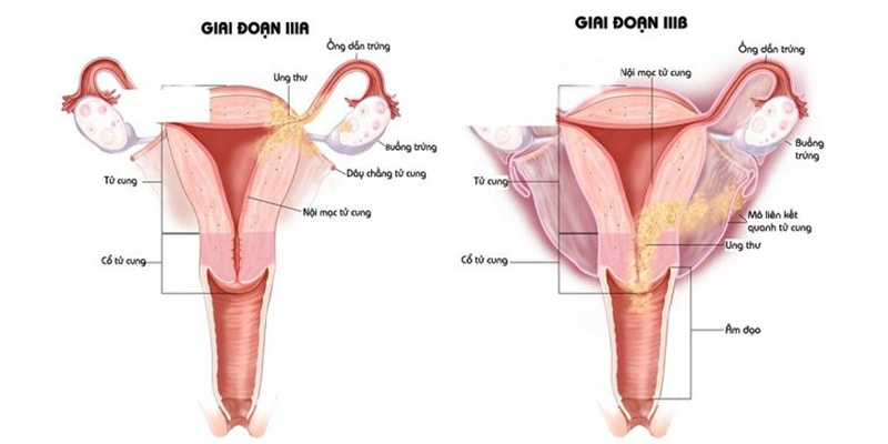 Hình ảnh ung thư cổ tử cung giai đoạn 3