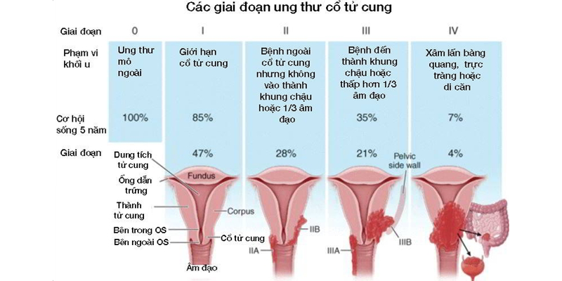 Hình ảnh ung thư cổ tử cung giai đoạn 4