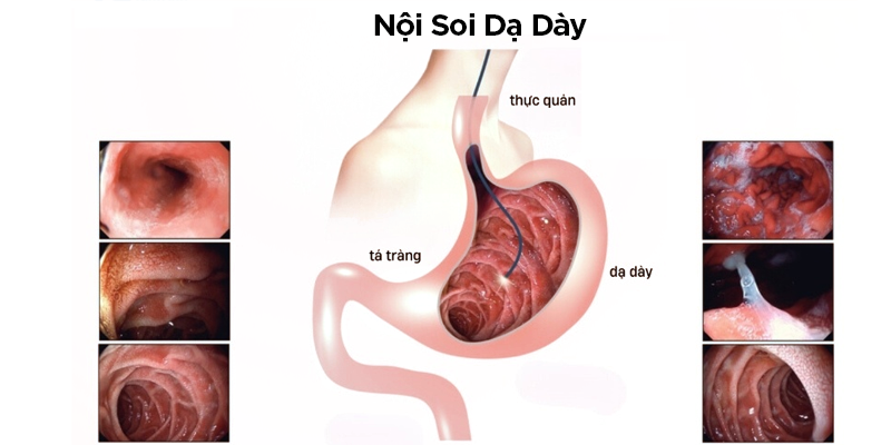 Nội soi là phương pháp tầm soát rất hiệu quả một số bệnh ung thư như dạ dày, đại trực tràng, thực quản…