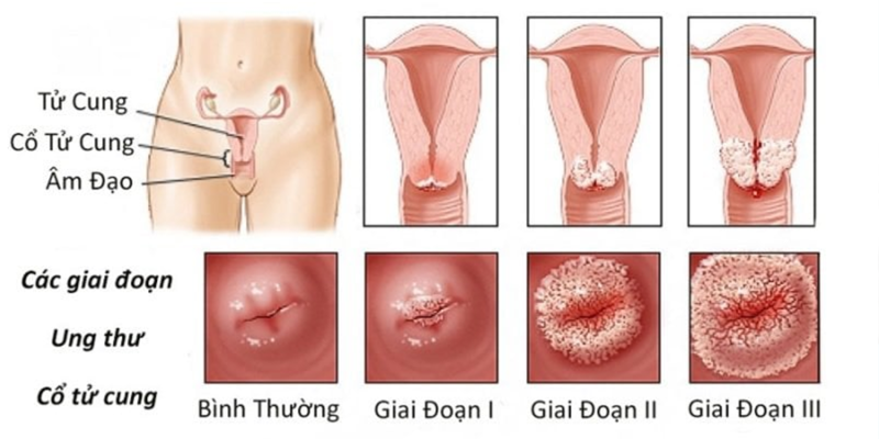 Ung thư cổ tử cung là tình trạng các tế bào bất thường ở niêm mạc cổ tử cung phát triển không kiểm soát