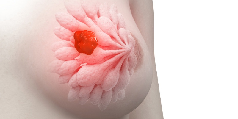 Xơ nang tuyến vú là một trong những bệnh lý phổ biến ở nữ giới