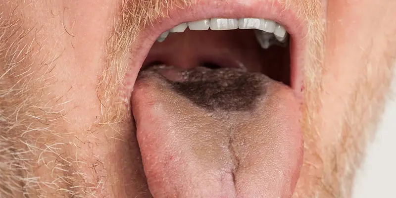 Màu sắc của lưỡi bị màu đen có thể là biểu hiện nghiêm trọng của bệnh lý như HIV