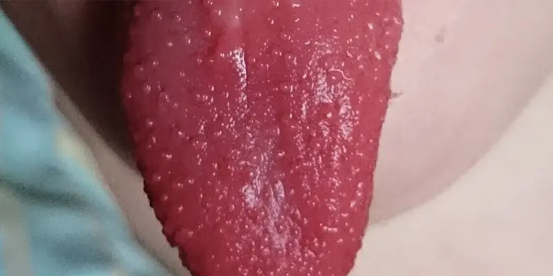 Màu sắc của lưỡi màu đỏ có thể là một trong những biểu hiện của bệnh Kawasaki