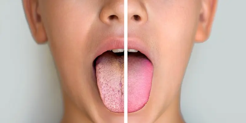 Màu sắc của lưỡi có màu vàng thường là do sự phát triển quá mức của vi khuẩn ở khoang miệng
