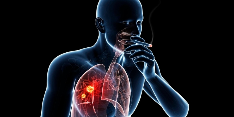 Hút thuốc lá là yếu tố nguy cơ chính dẫn đến ung thư phổi không tế bào nhỏ