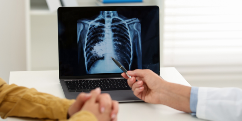 Ung thư phổi ho ra máu sống được bao lâu còn phụ thuộc vào nhiều yếu tố khác nhau