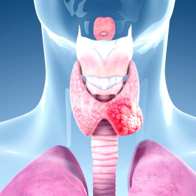 Các giai đoạn ung thư tuyến giáp thể nhú và phương pháp điều trị