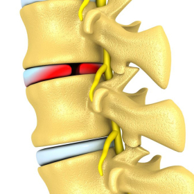 Các khối u tủy sống: Triệu chứng bạn không nên bỏ qua