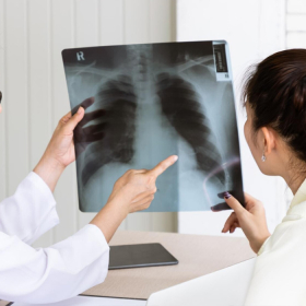 Chụp X quang có phát hiện ung thư phổi không​? Ưu và nhược điểm chụp X quang