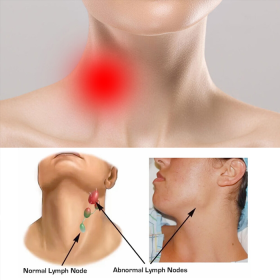 Các đặc điểm u lympho Hodgkin và cơ chế gây ra bệnh
