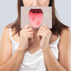 Dấu hiệu của ung thư lưỡi bạn dễ bỏ qua nhất