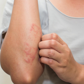Nhận biết dấu hiệu ung thư da giai đoạn đầu để điều trị kịp thời