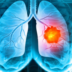 Cảnh báo dấu hiệu ung thư phổi sớm bạn tuyệt đối không nên bỏ qua