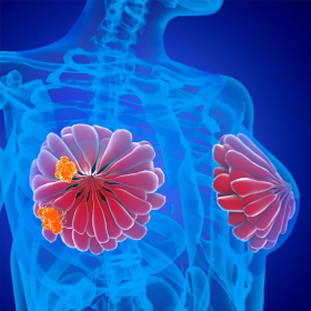 Các dấu hiệu ung thư vú cảnh báo bạn cần đi khám ngay