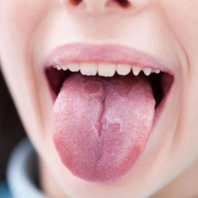 Đầu lưỡi nổi hột đỏ là bệnh gì? Nguyên nhân và cách xử lý