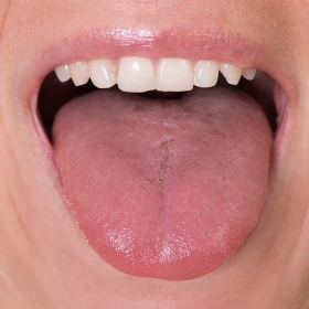 Đau rát lưỡi kéo dài có nguy hiểm không? Chữa đau rát lưỡi tại nhà