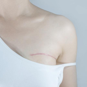 Điều trị ung thư vú gồm những phương pháp nào?