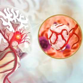 Các giai đoạn ung thư não và tiên lượng từng giai đoạn