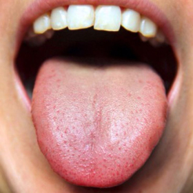 Lưỡi có đốm đỏ là bệnh gì? Nguyên nhân và cách xử trí