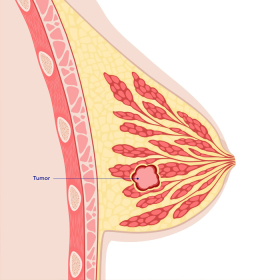 Mô vú dày đặc là gì? Hiểu đúng để bảo vệ sức khỏe phụ nữ