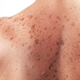 Cảnh báo các nguyên nhân ung thư da hắc tố dễ bị bỏ qua