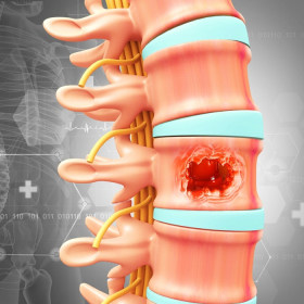 Nguyên nhân ung thư tủy sống và yếu tố nguy cơ