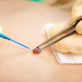 Những phương pháp điều trị ung thư da hiệu quả được áp dụng hiện nay
