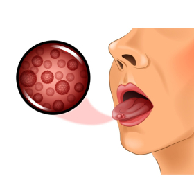 Nổi mụn ở lưỡi là dấu hiệu bệnh gì? Điều trị như thế nào