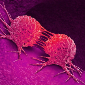 Quá trình phát triển ung thư vú nhanh đến mức nào?