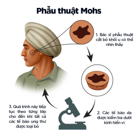 Phẫu thuật Mohs: Điều trị ung thư da, đối tượng, quy trình thực hiện