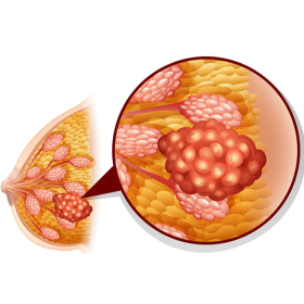 Khi nào nên phẫu thuật ung thư vú: Quy trình và những điều cần biết